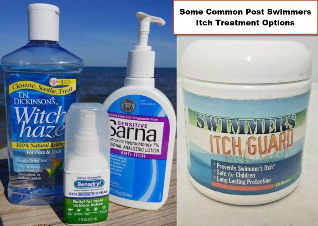 swimmers itch